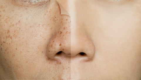 Enlightening Facts About Dark Spots and Hyperpigmentation