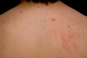 Folliculitis Lesions