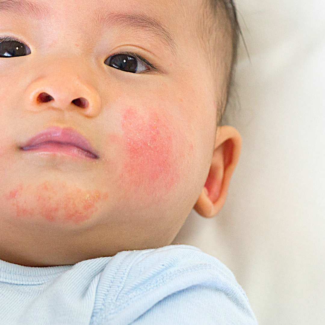 Eczema Baby Closeup