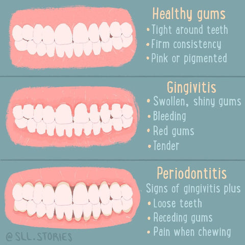 Why is it Important to Take Care of Your Gums?