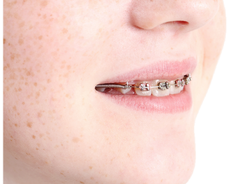 When can I start correcting irregular teeth?