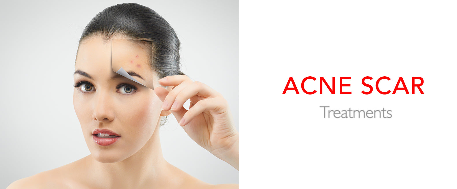 Acne scar treatments