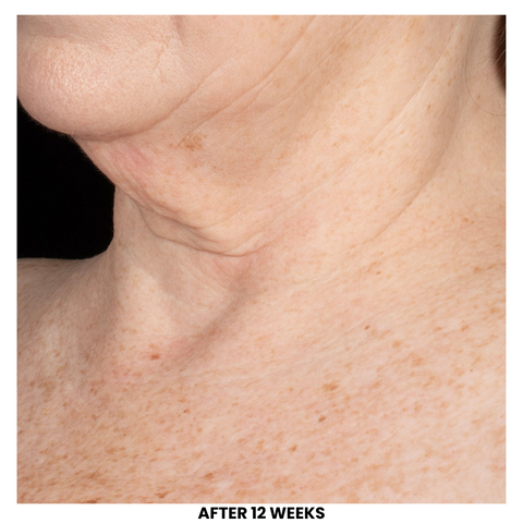 After ELASTIderm® Neck and Décolleté Concentrate