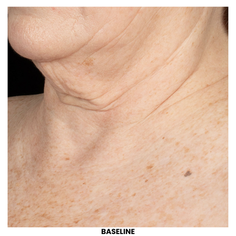 Before ELASTIderm® Neck and Décolleté Concentrate