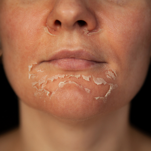 close up of woman's face with peeling chin