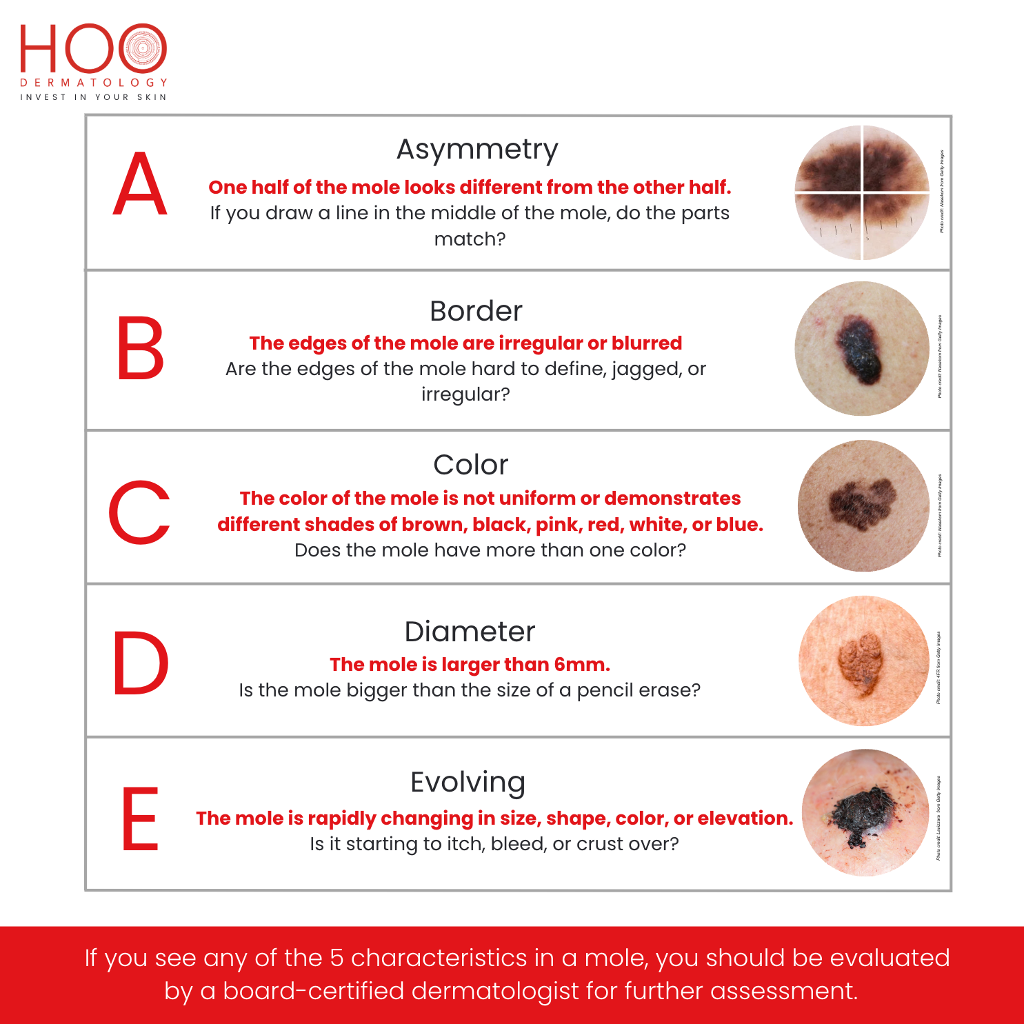 Monitor your moles with ABCDE