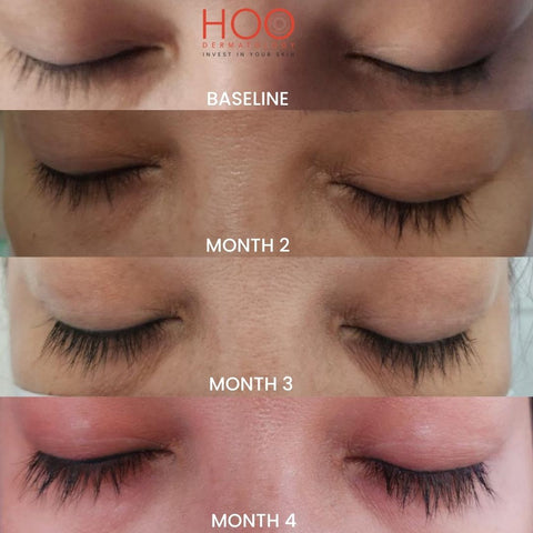 Obagi Nu-Cil Eyelash Results from HOO Dermatology