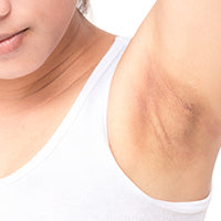 Girl with dark underarms by hoodermatology.com