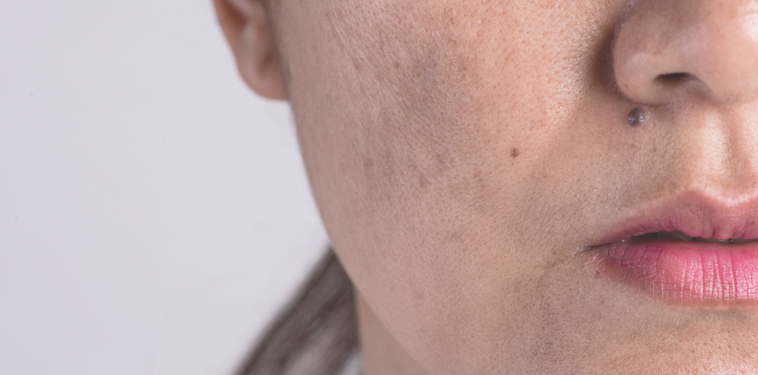 Woman with hyperpigmentation on the cheek