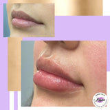 What is the best lip filler? No more mistakes with lip filler the secret of lip filler Buy the lips you’ve always dreamed of you deserve it lip injections Are a great way to make sure those lips look natural and realistic. Check out lip injections. Lip plumper. Get the lips you’ve always wanted before and after from real happy patients life is short buy the lips lip filler, lip injections, lip augmentation, lip plumper, lip plumping, lip enlargement, how do you get bigger lips, how to get fuller lips, how to make your lips bigger, how to get plump your lips, bee sting lips, the stone lips, smile re-design, Lip filler cost, Juvéderm, filler for lips, Juvéderm lips before and after photos, how to make a smile bigger, Botox lips, dermal filler 92336 inland empire nurse Mel NP aspire weight loss & wellness Fontana