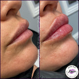 What is the best lip filler? No more mistakes with lip filler the secret of lip filler Buy the lips you’ve always dreamed of you deserve it lip injections Are a great way to make sure those lips look natural and realistic. Check out lip injections. Lip plumper. Get the lips you’ve always wanted before and after from real happy patients life is short buy the lips lip filler, lip injections, lip augmentation, lip plumper, lip plumping, lip enlargement, how do you get bigger lips, how to get fuller lips, how to make your lips bigger, how to get plump your lips, bee sting lips, the stone lips, smile re-design, Lip filler cost, Juvéderm, filler for lips, Juvéderm lips before and after photos, how to make a smile bigger, Botox lips, dermal filler 92336 inland empire nurse Mel NP aspire weight loss & wellness Fontana