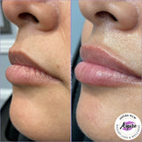 Lip Filler before and after lip injections lip fillers Fontana inland empire 92336 nurse Mel NP Aspire Weight Loss & Wellness