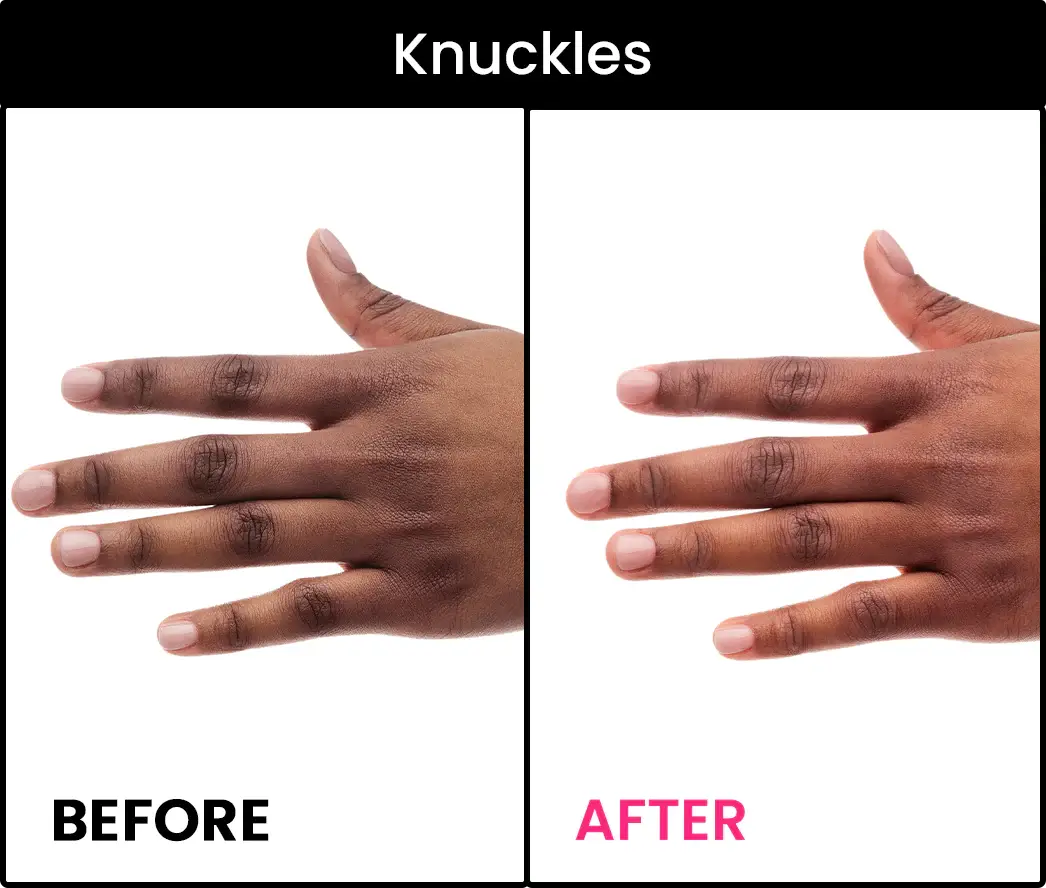 hyperpigmentation cream for knuckles