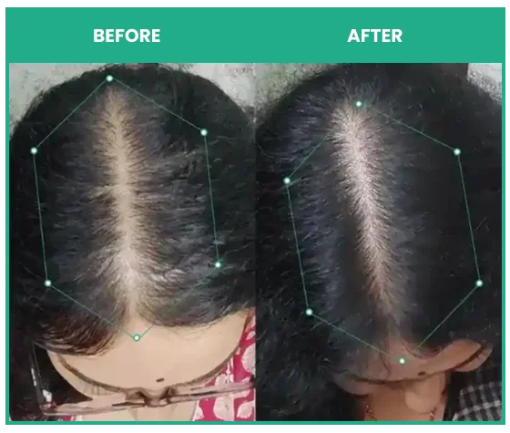 before and after results of using rosemary shampoo with hair growth serum