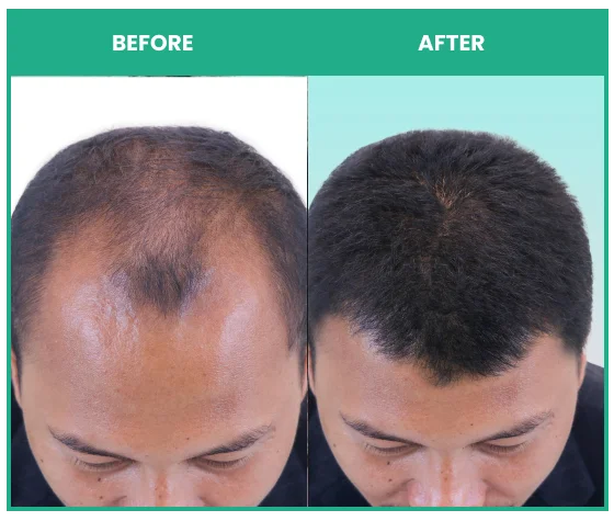 Results of rosemary shampoo combined with hair growth serum