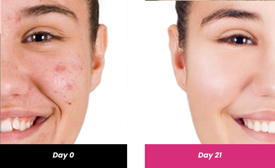 before and after salicylic acid serum