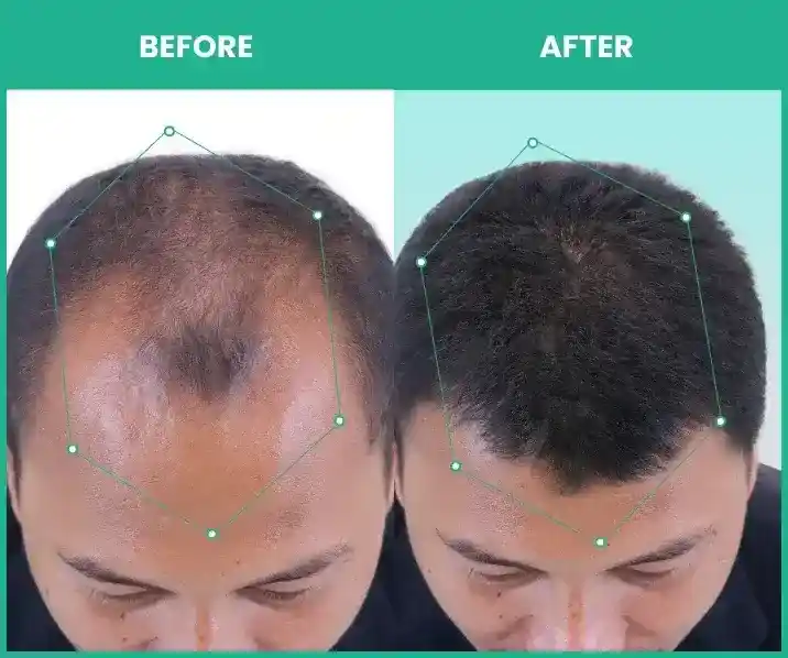 results after using combo of rosemary essential oil and hair serum in men