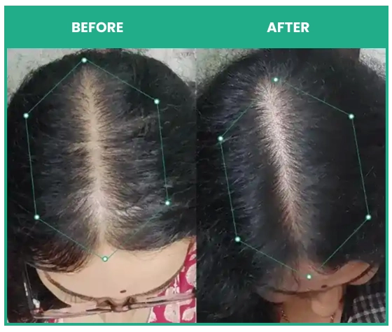 results after using thriveco rosemary shampoo and rosemary conditioner combo with hair growth serum