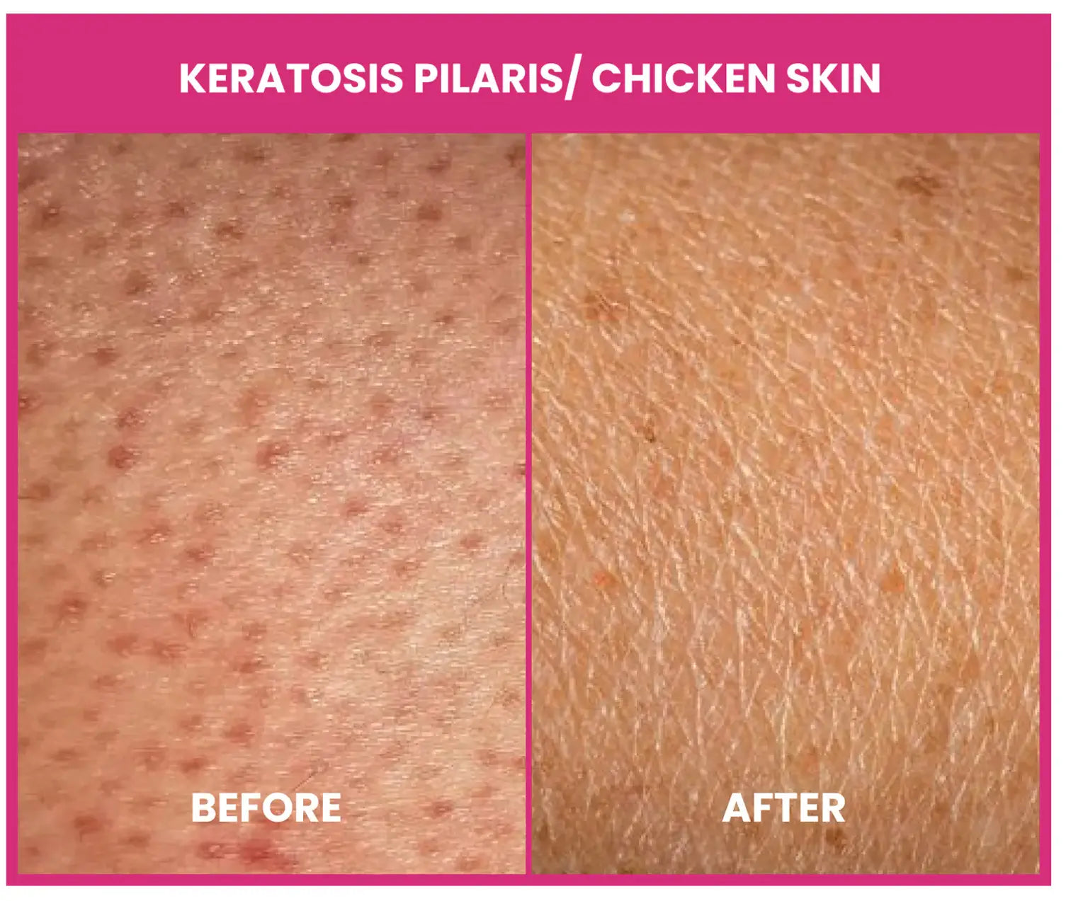 keratosis pilaris legs treatment