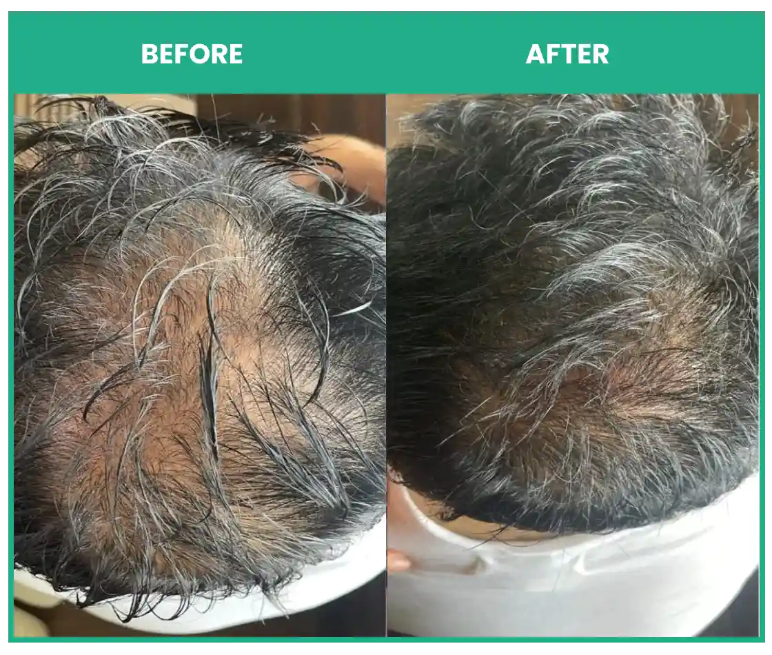 before and after using thriveco hair growth serum for men