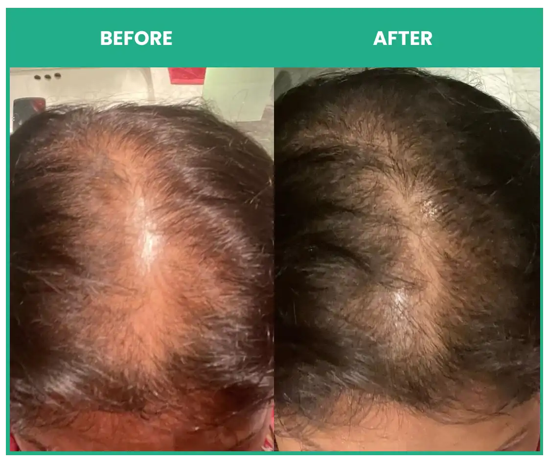 before and after using thriveco hair serum 2.0