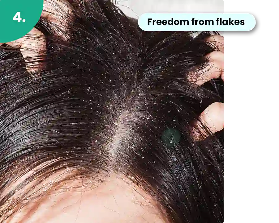 best scalp treatment for dandruff