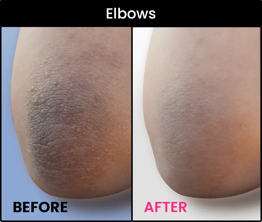 best dark spots removal cream for elbows