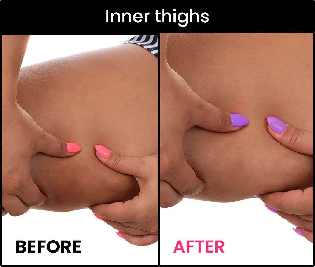 inner thighs pigmentation removal cream