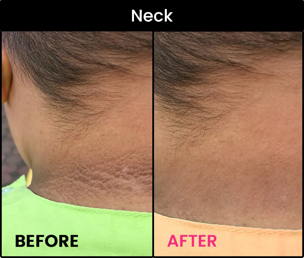 Neck dark spots removal cream