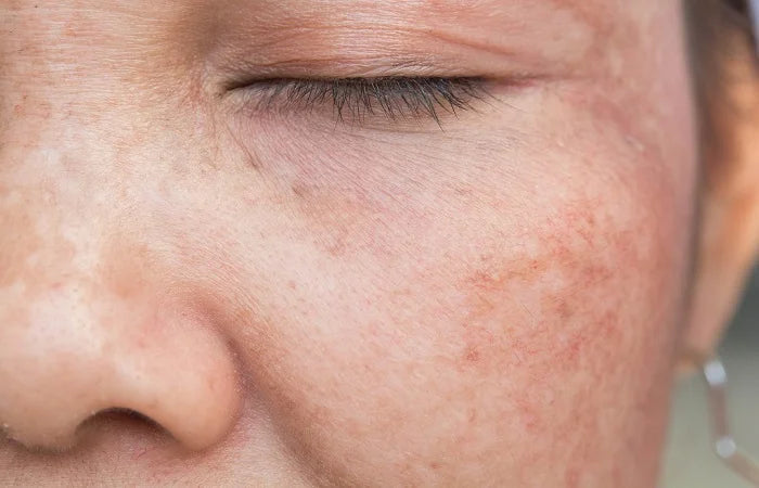 Hyperpigmentation Causes