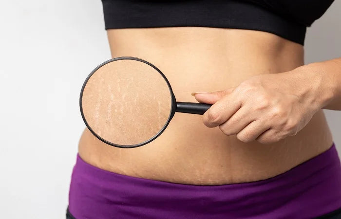 The Ultimate Guide: 7 Effective Ways to Prevent Stretch Marks