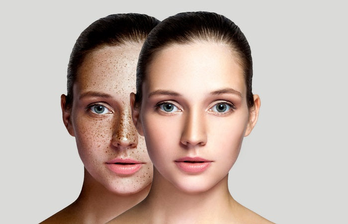 Types of Hyperpigmentation