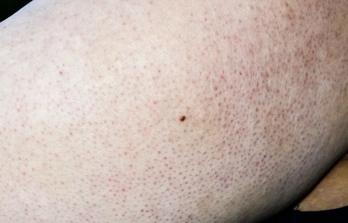 Keratosis Pilaris