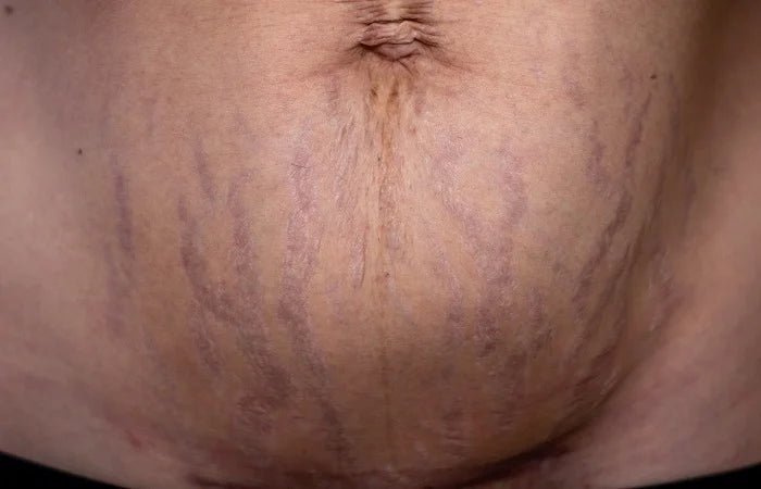 Purple Stretch Marks