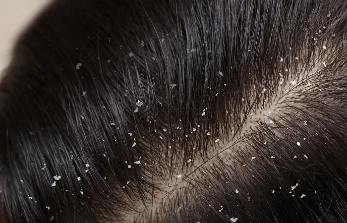 Dandruff