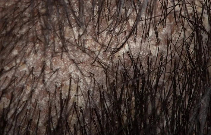 What Is Scalp Peeling?