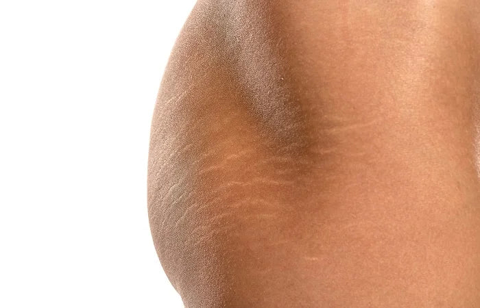 Tanning Can Help Cover Up Stretch Marks