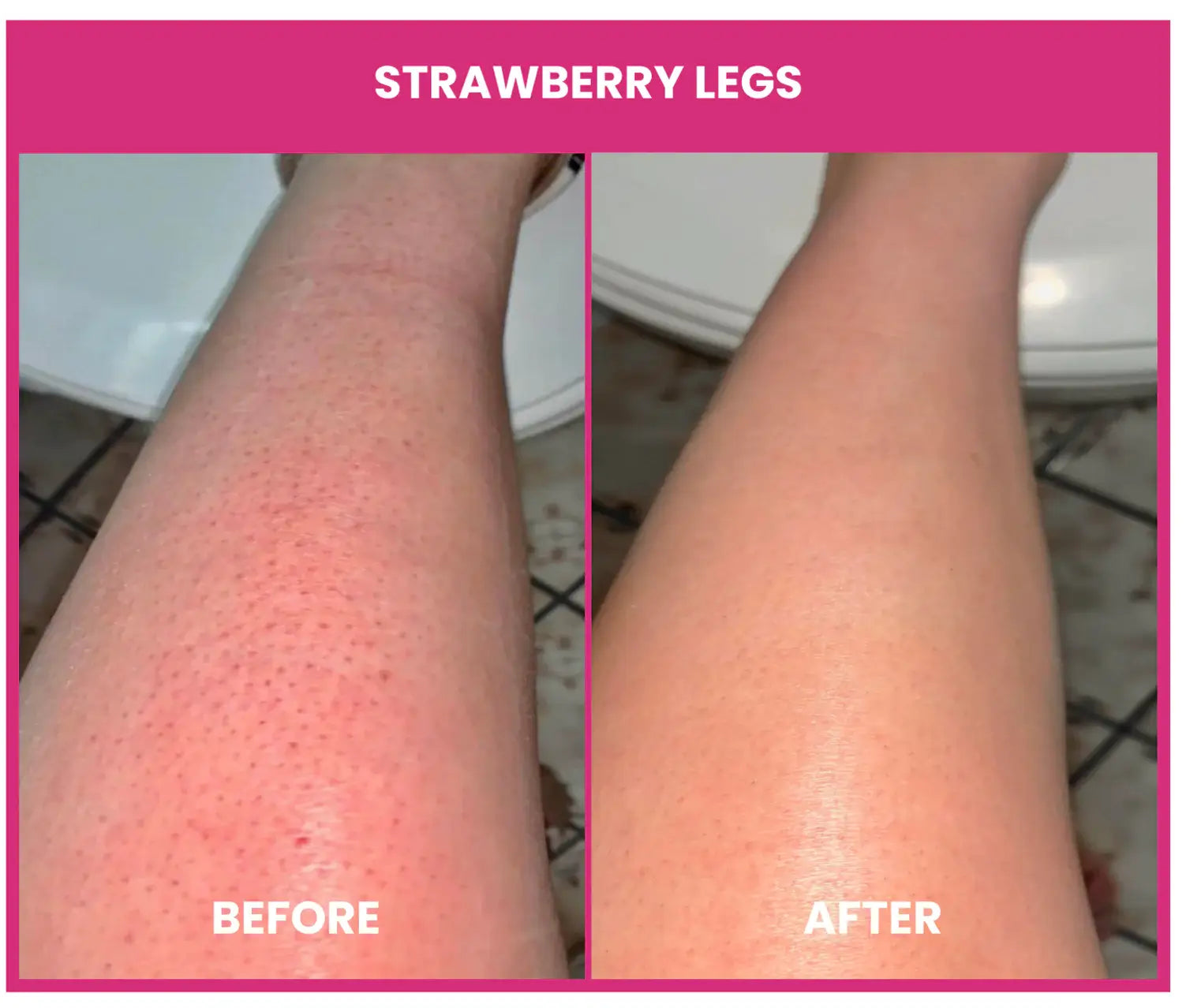 best exfoliator for strawberry legs