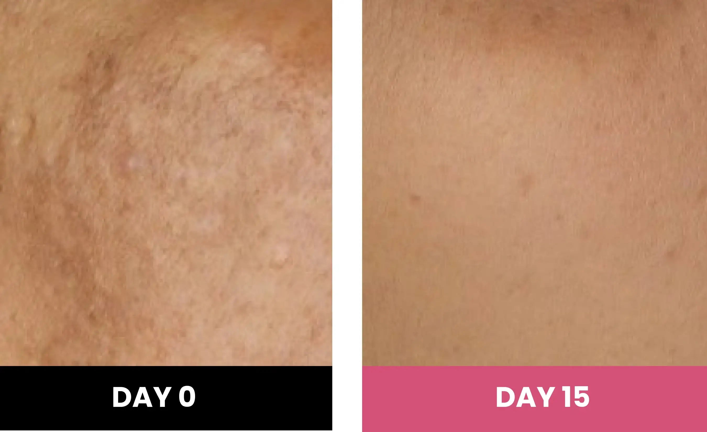 ThriveCo Goodbye Acne Kit helps 79% subjects achieved clear skin in 15 days