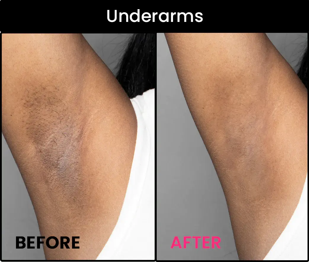 Underarms black dark spot remover cream