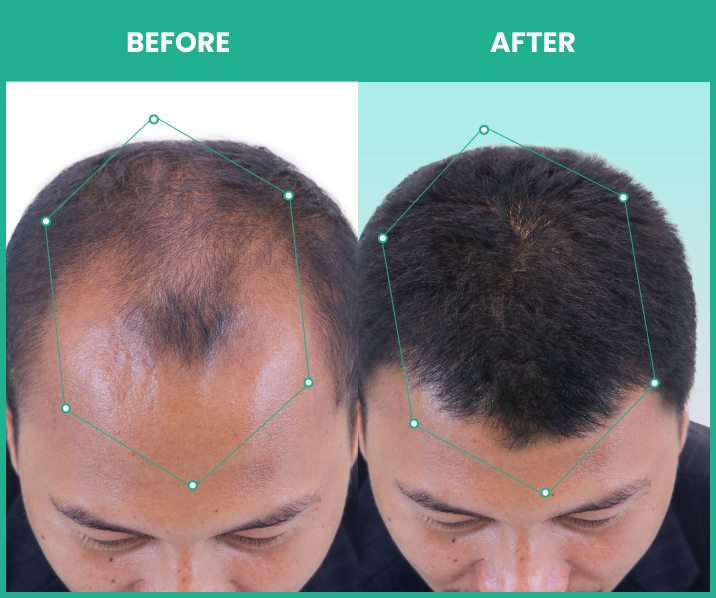 results after using thriveco mens hair growth serum