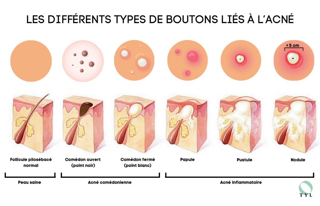 Les différents types de boutons liés à l'acné