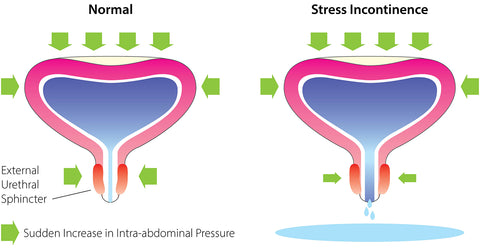 stress incontinence