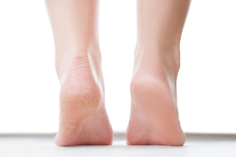 Pelle secca dei piedi – espertodelpiede.it