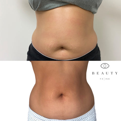 What is Body Sculpting Cavitation? 