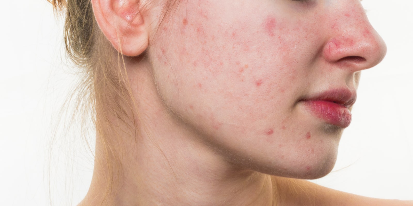 Acne on womans skin