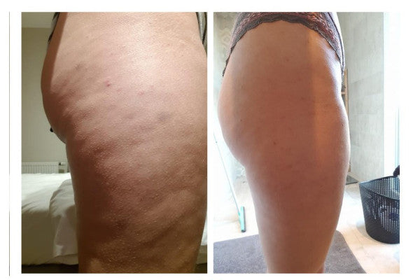 avant apres avis appareil aspirateur anti cellulite