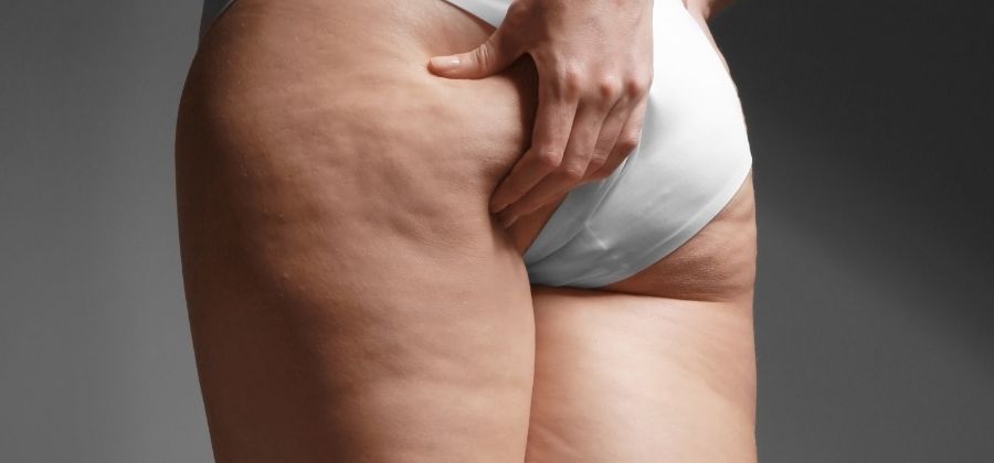 cellulite