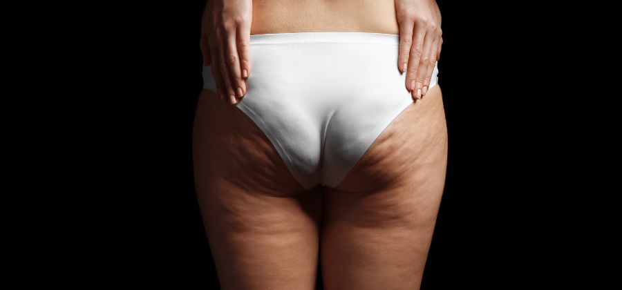 cellulite femme