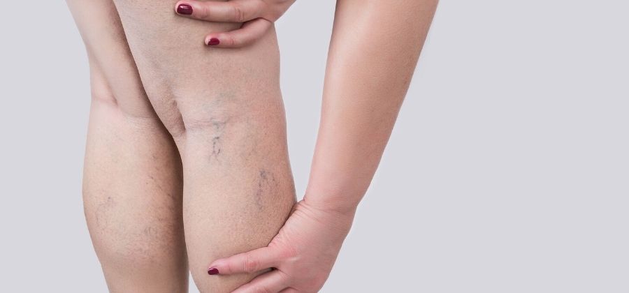 Corde à sauter et cellulite : bienfaits, exercices, astuces